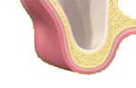 Mandiule supérieur : hauteur d'os insuffisante pour la pose d'implant